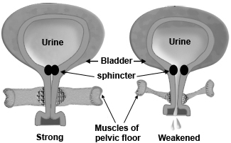 Urinary incontinence - Guardian, I.D.A. and Remedy'sRx